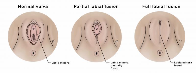 Labial Fusion In Children KidsHealth NZ